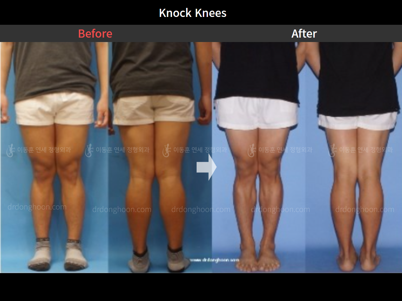 Before and after adult knock knees, case 8259196, image 1, Dr. Donghoon institute (DALRI)