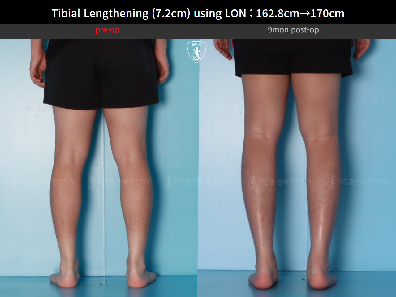 Before and after cll lon, case 124820559, image 8, Dr. Donghoon institute (DALRI)