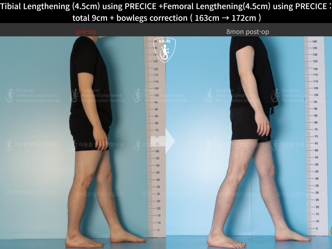 Before and after cll precice, case 13912585, image 8, Dr. Donghoon institute (DALRI)