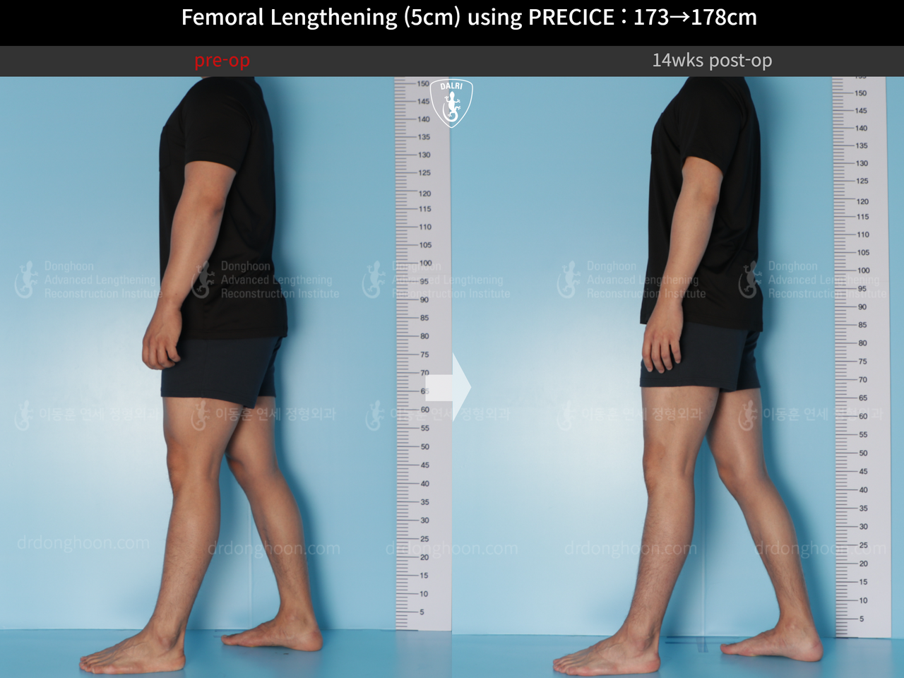 Before and after cll precice, case 14448457, image 4, Dr. Donghoon institute (DALRI)
