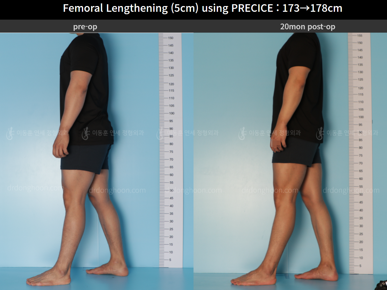Before and after cll precice, case 4573533, image 4, Dr. Donghoon institute (DALRI)