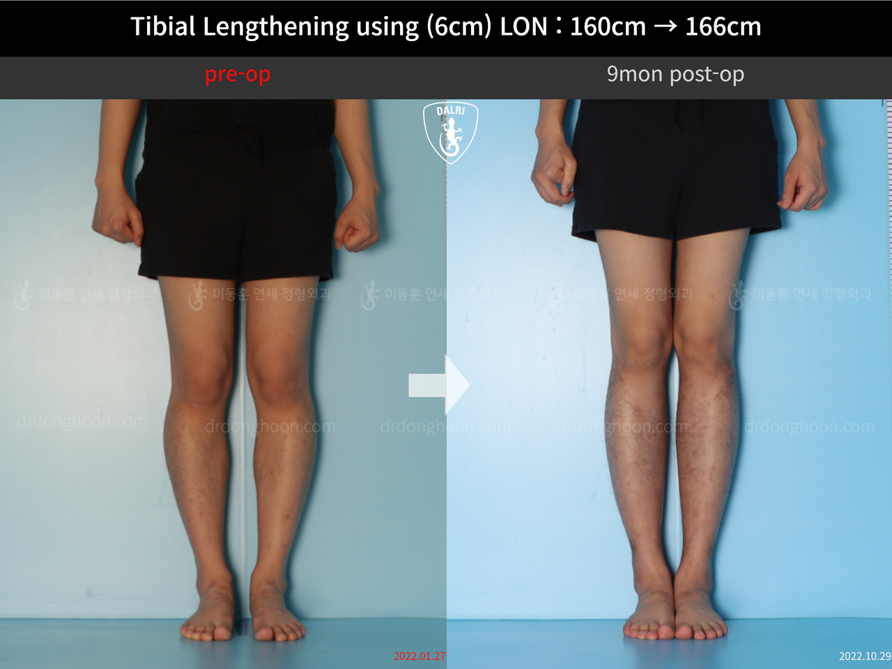Before and after cll lon, case 13326359, image 7, Dr. Donghoon institute (DALRI)