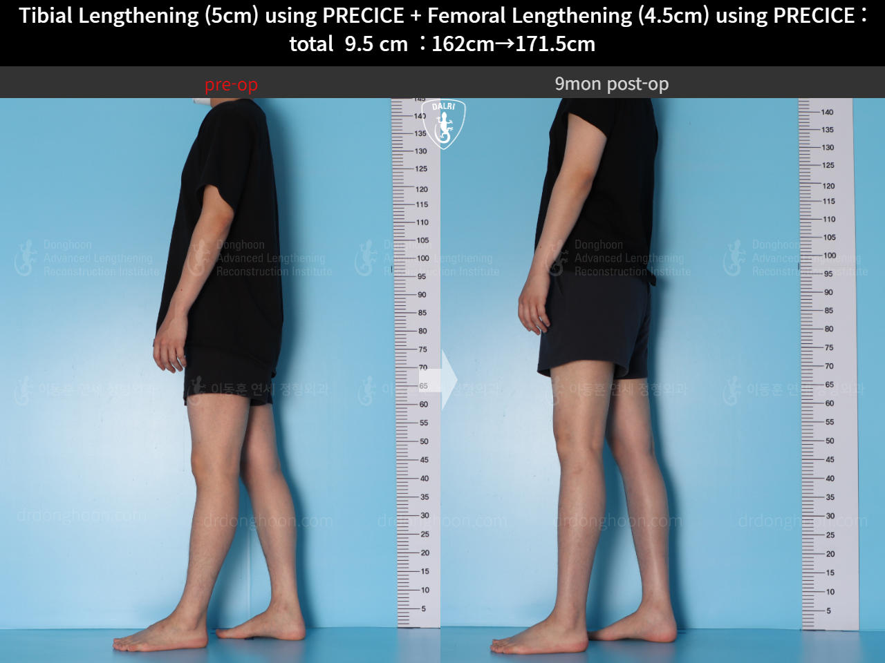 Before and after cll precice, case 15344460, image 7, Dr. Donghoon institute (DALRI)