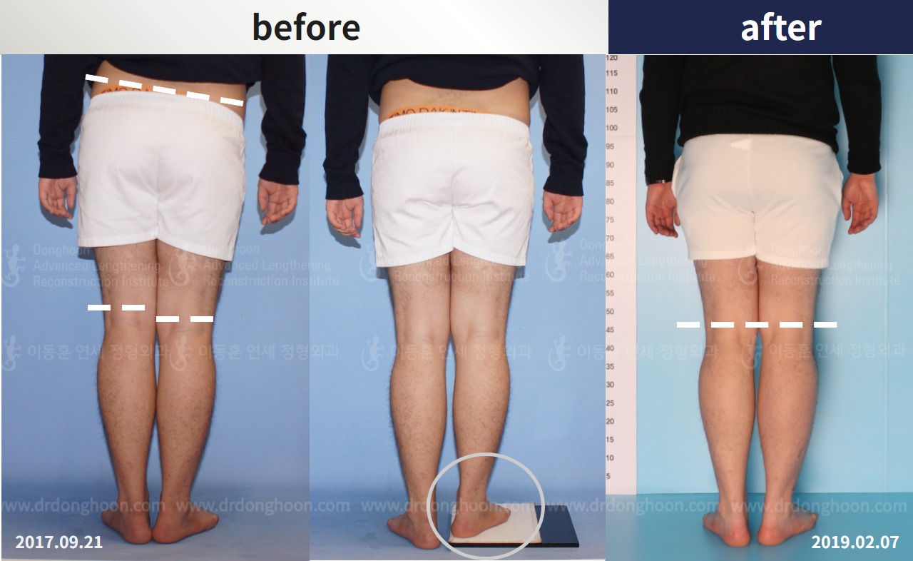 Before and after adult lld, case 4320305, image 2, Dr. Donghoon institute (DALRI)