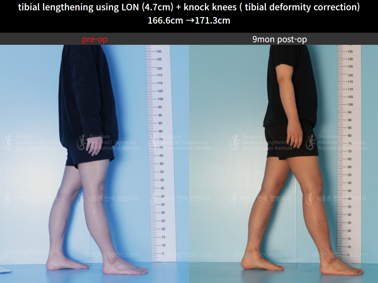 Before and after cll + deformity correction, case 8583829, image 4, Dr. Donghoon institute (DALRI)