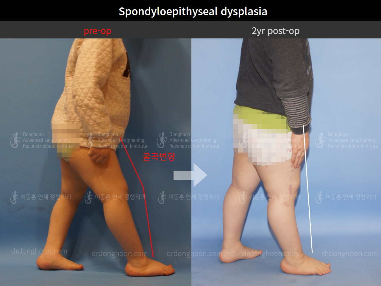 Before and after paediatric congenital condition, case 4304778, image 4, Dr. Donghoon institute (DALRI)