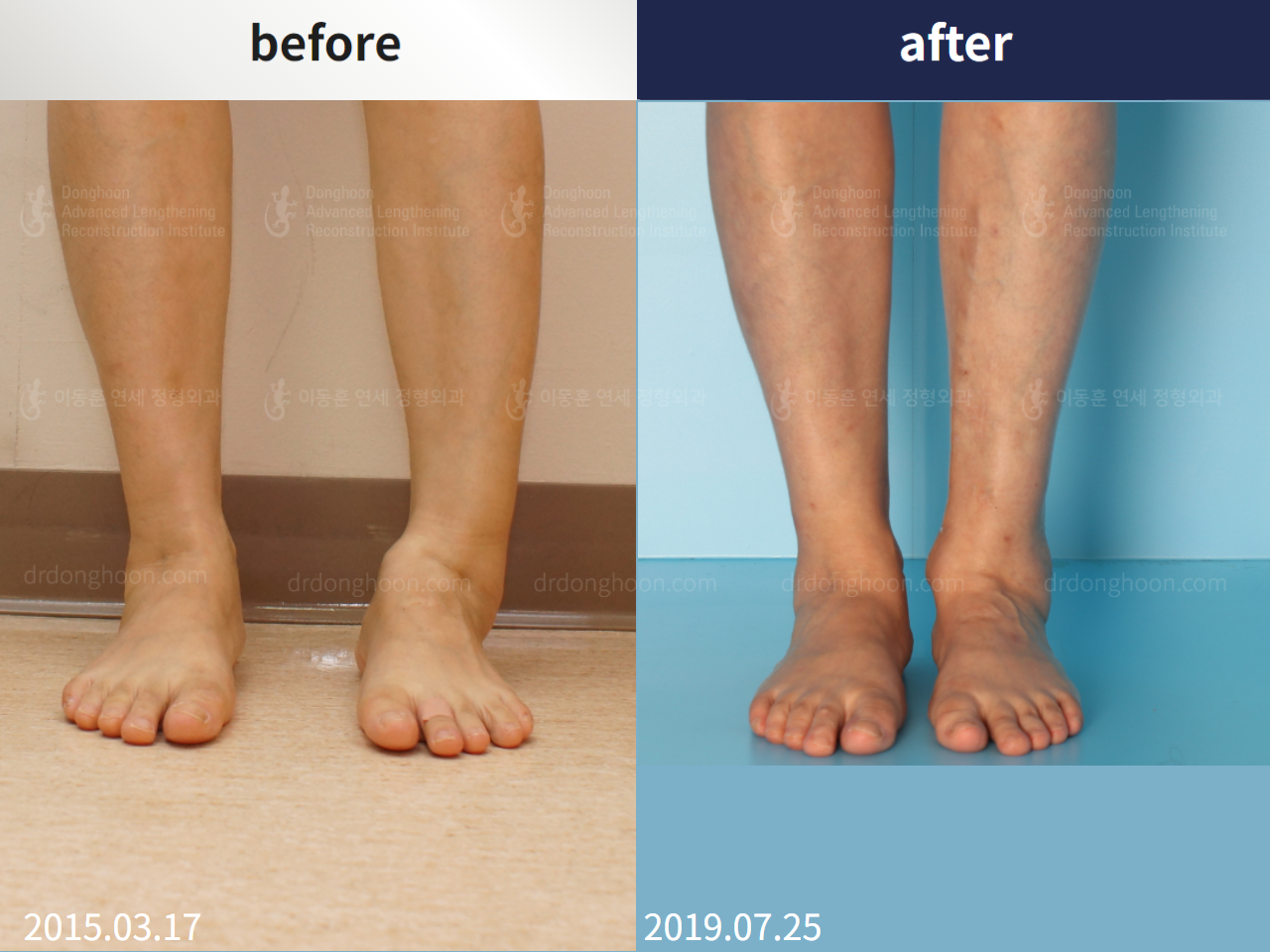 Before and after foot & ankle deformity, case 4248108, image 2, Dr. Donghoon institute (DALRI)