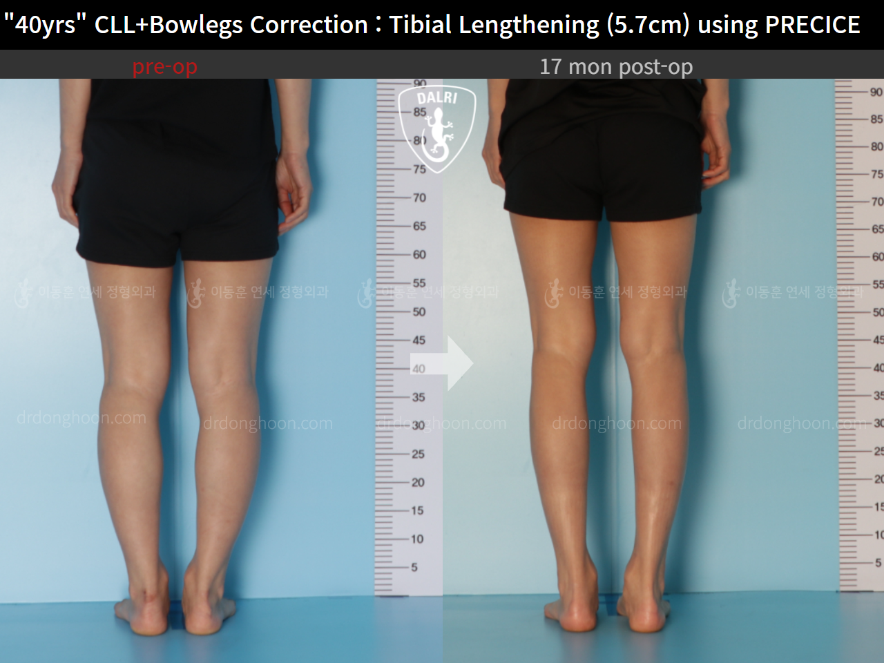 Before and after cll + deformity correction, case 9180907, image 6, Dr. Donghoon institute (DALRI)