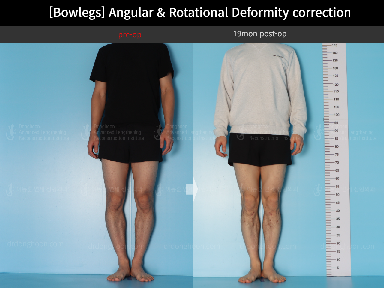 Before and after adult bowlegs, case 18306379, image 3, Dr. Donghoon institute (DALRI)