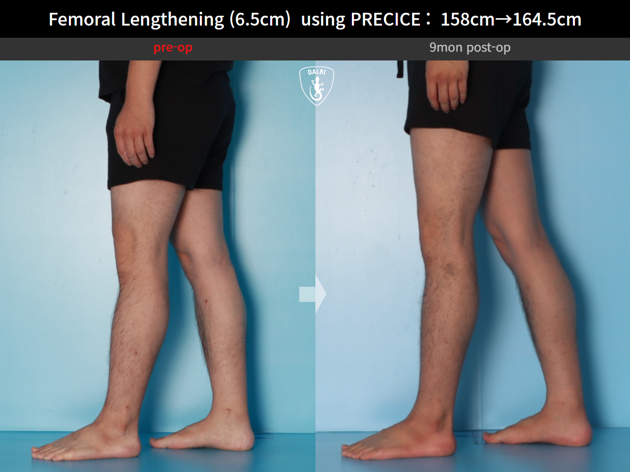 Before and after cll precice, case 28297898, image 9, Dr. Donghoon institute (DALRI)