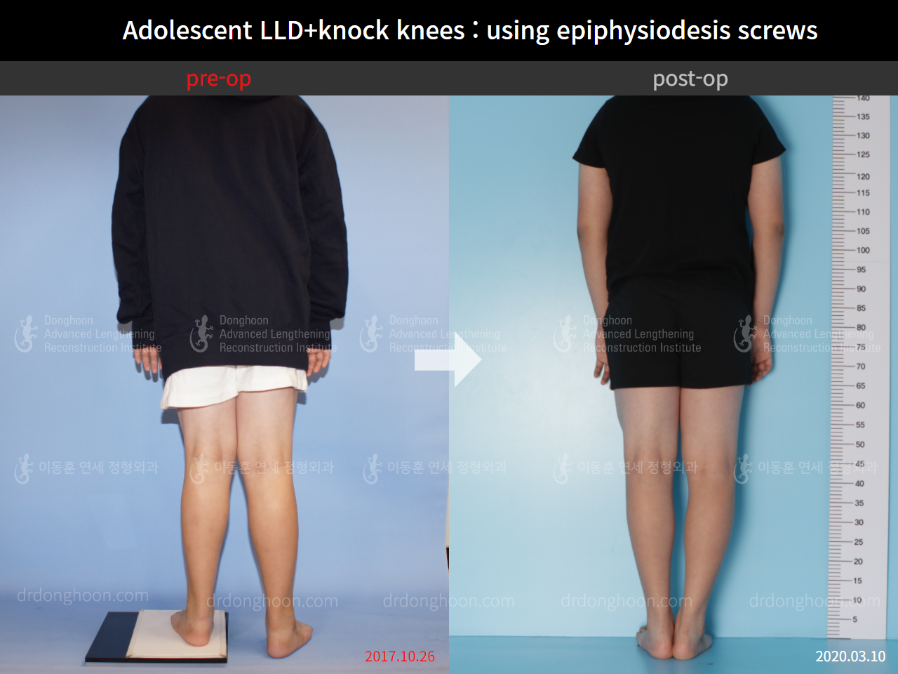 Before and after complex deformity, case 8835405, image 4, Dr. Donghoon institute (DALRI)