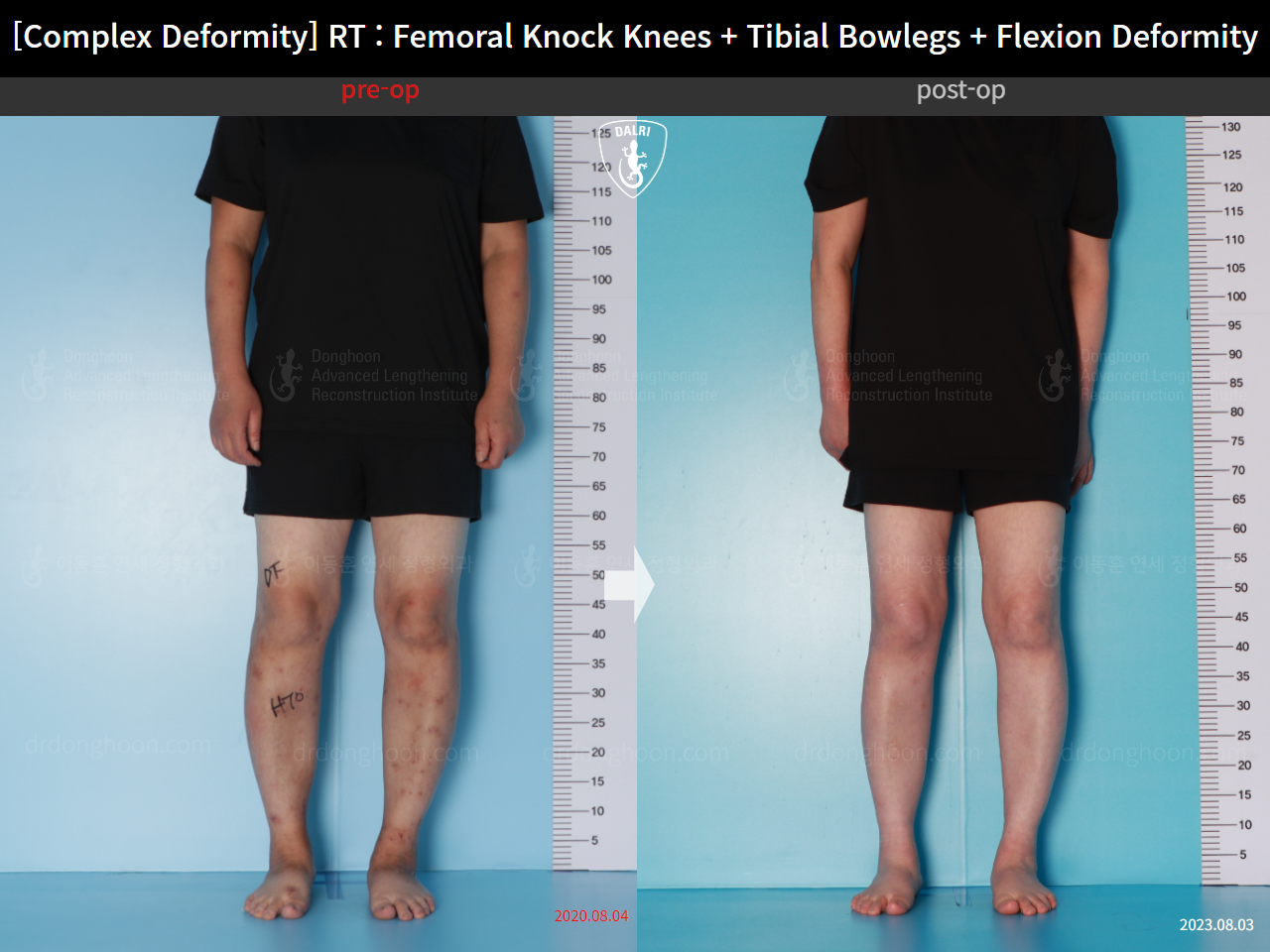 Before and after adult bowlegs, case 16507044, image 2, Dr. Donghoon institute (DALRI)