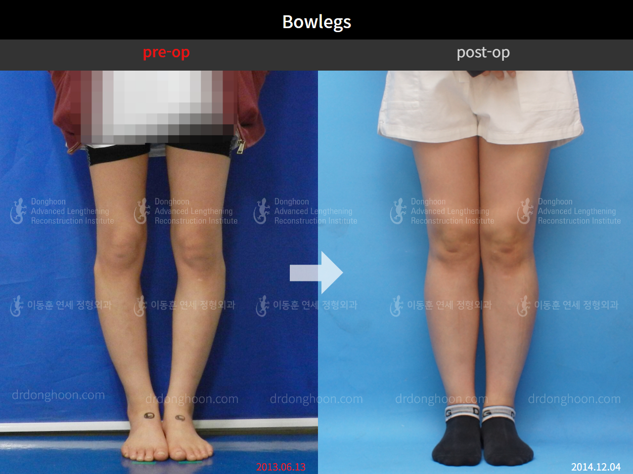 Before and after adult bowlegs, case 4310996, image 3, Dr. Donghoon institute (DALRI)