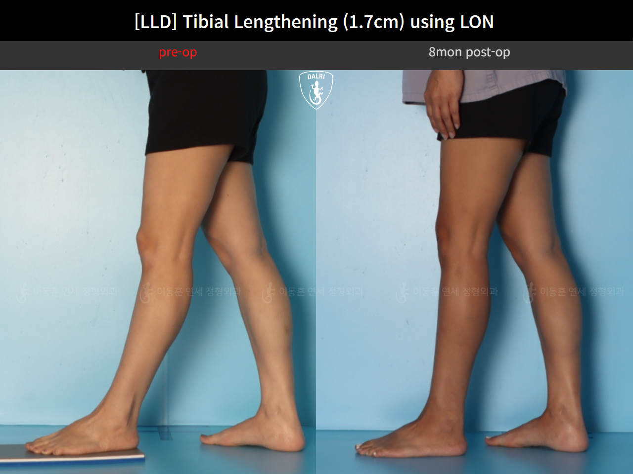 Before and after adult lld, case 126715948, image 8, Dr. Donghoon institute (DALRI)