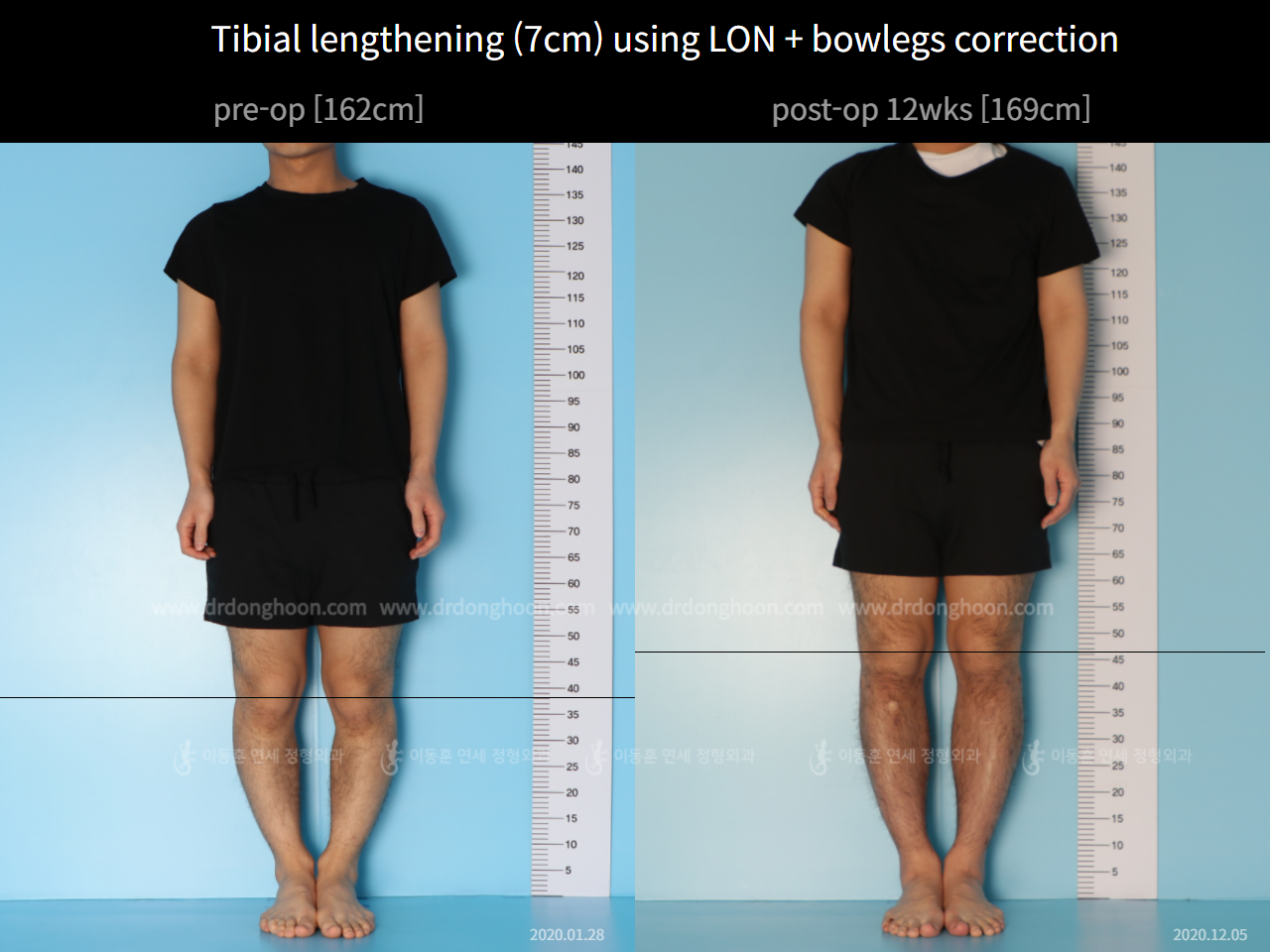 Tibial Lengthening (7cm) Using LON + Bowlegs Correction :162cm→169cm ...