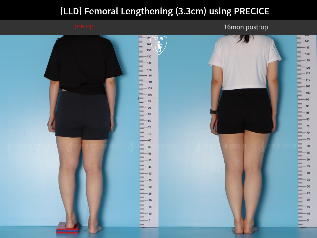 Before and after adult lld, case 125639660, image 2, Dr. Donghoon institute (DALRI)