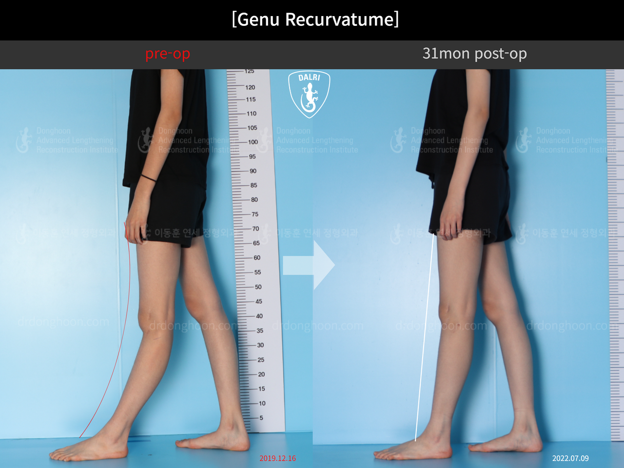 Before and after genu recurvatum, case 12484595, image 2, Dr. Donghoon institute (DALRI)