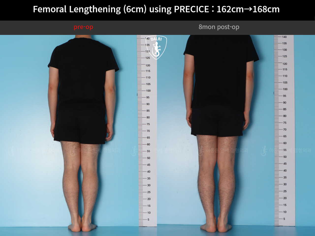 Before and after cll precice, case 52565195, image 2, Dr. Donghoon institute (DALRI)