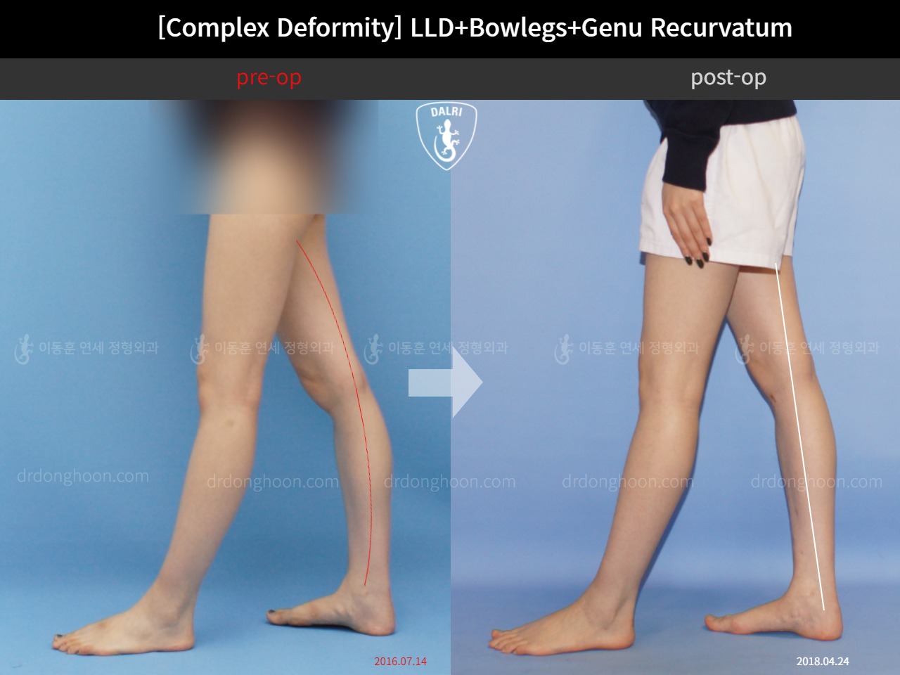 Before and after adult lld, case 11648318, image 7, Dr. Donghoon institute (DALRI)