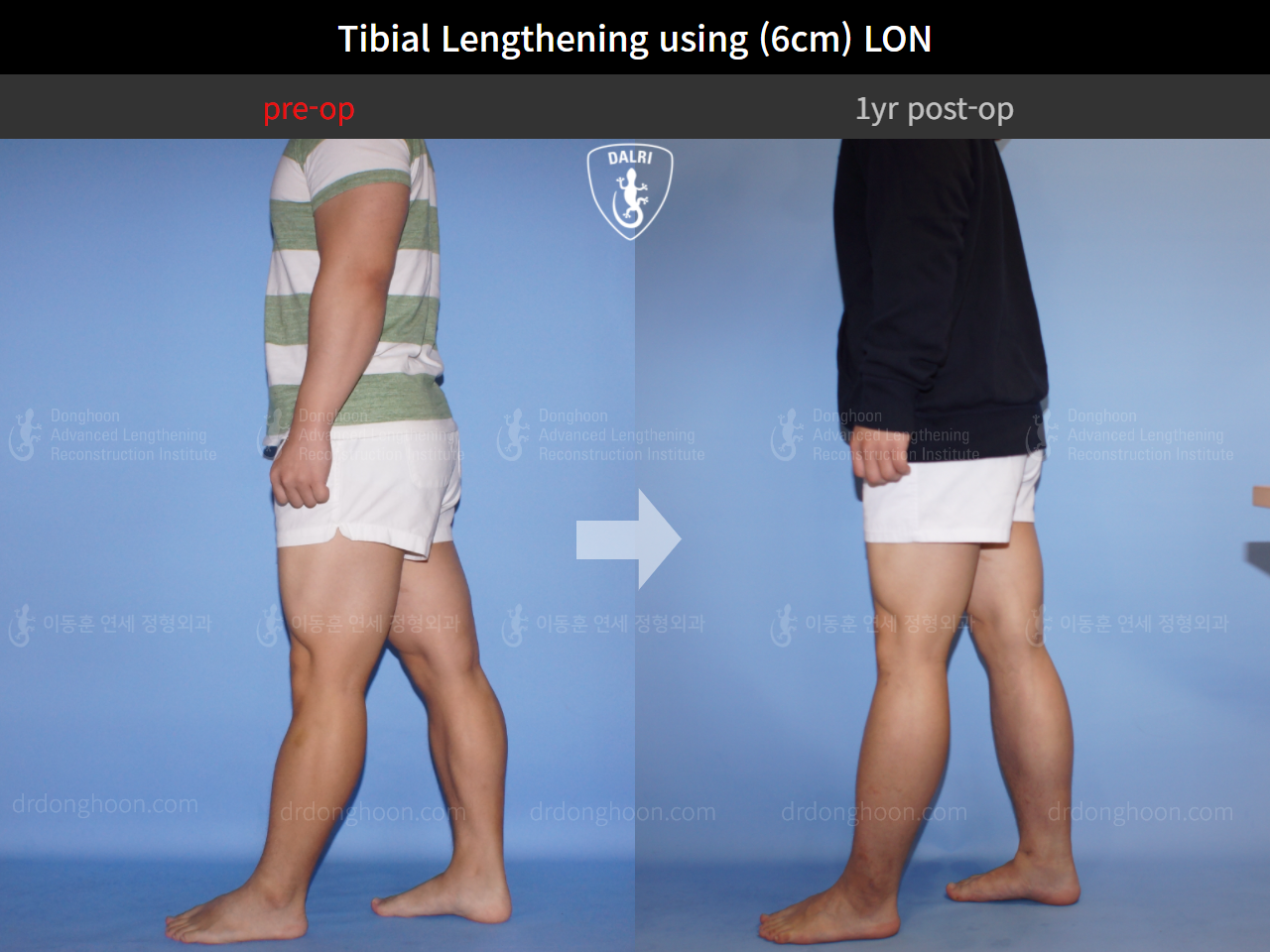 Before and after cll lon, case 4323461, image 3, Dr. Donghoon institute (DALRI)