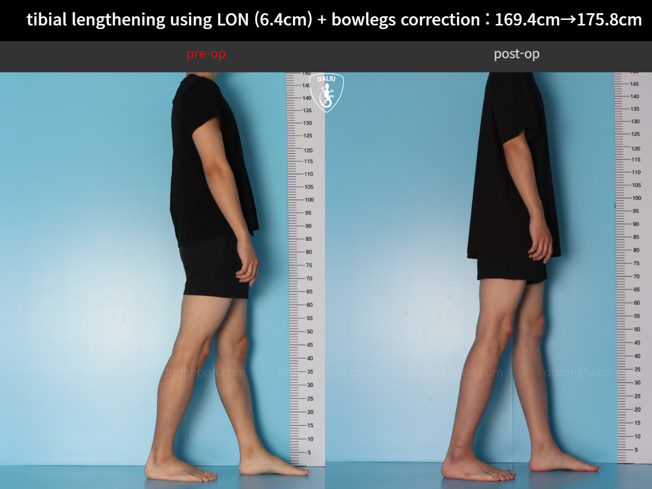 Before and after cll + deformity correction, case 36736776, image 4, Dr. Donghoon institute (DALRI)