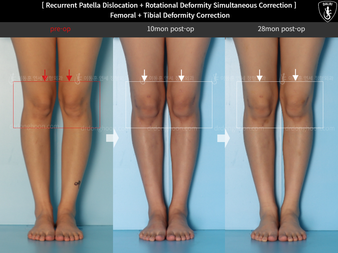 Before and after adult bowlegs, case 15131364, image 3, Dr. Donghoon institute (DALRI)