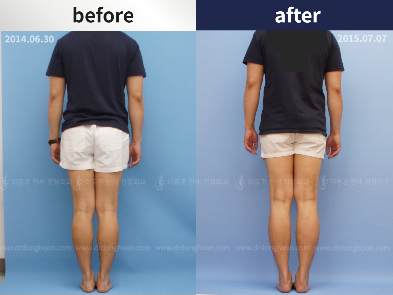 Before and after cll lon, case 4323961, image 3, Dr. Donghoon institute (DALRI)
