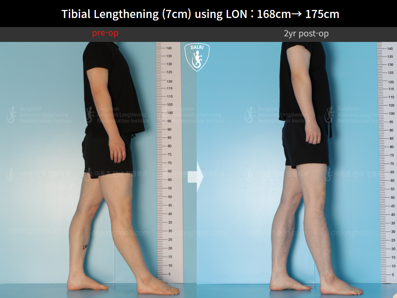 Before and after cll lon, case 14978046, image 5, Dr. Donghoon institute (DALRI)