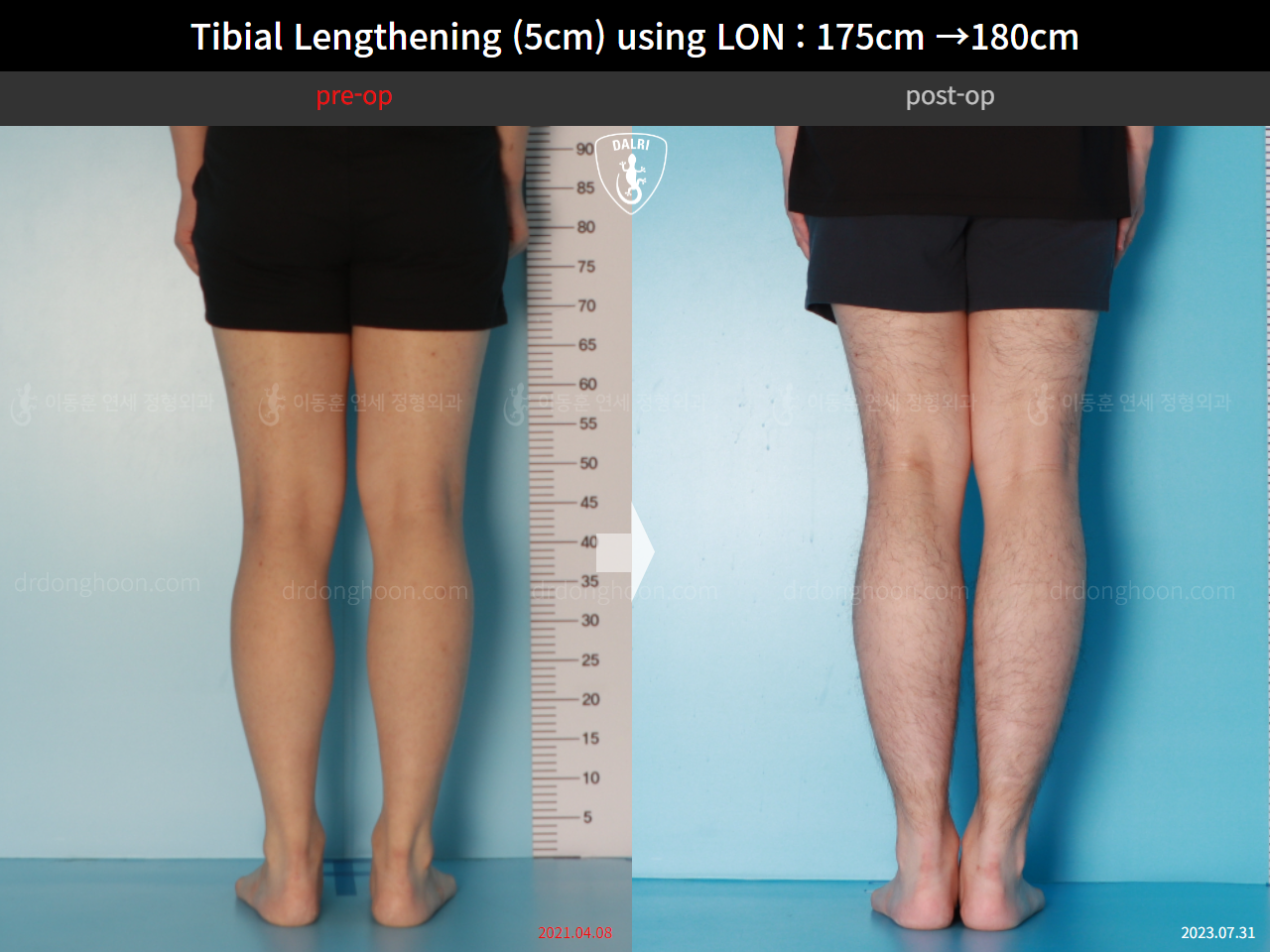 Before and after cll lon, case 15931051, image 6, Dr. Donghoon institute (DALRI)