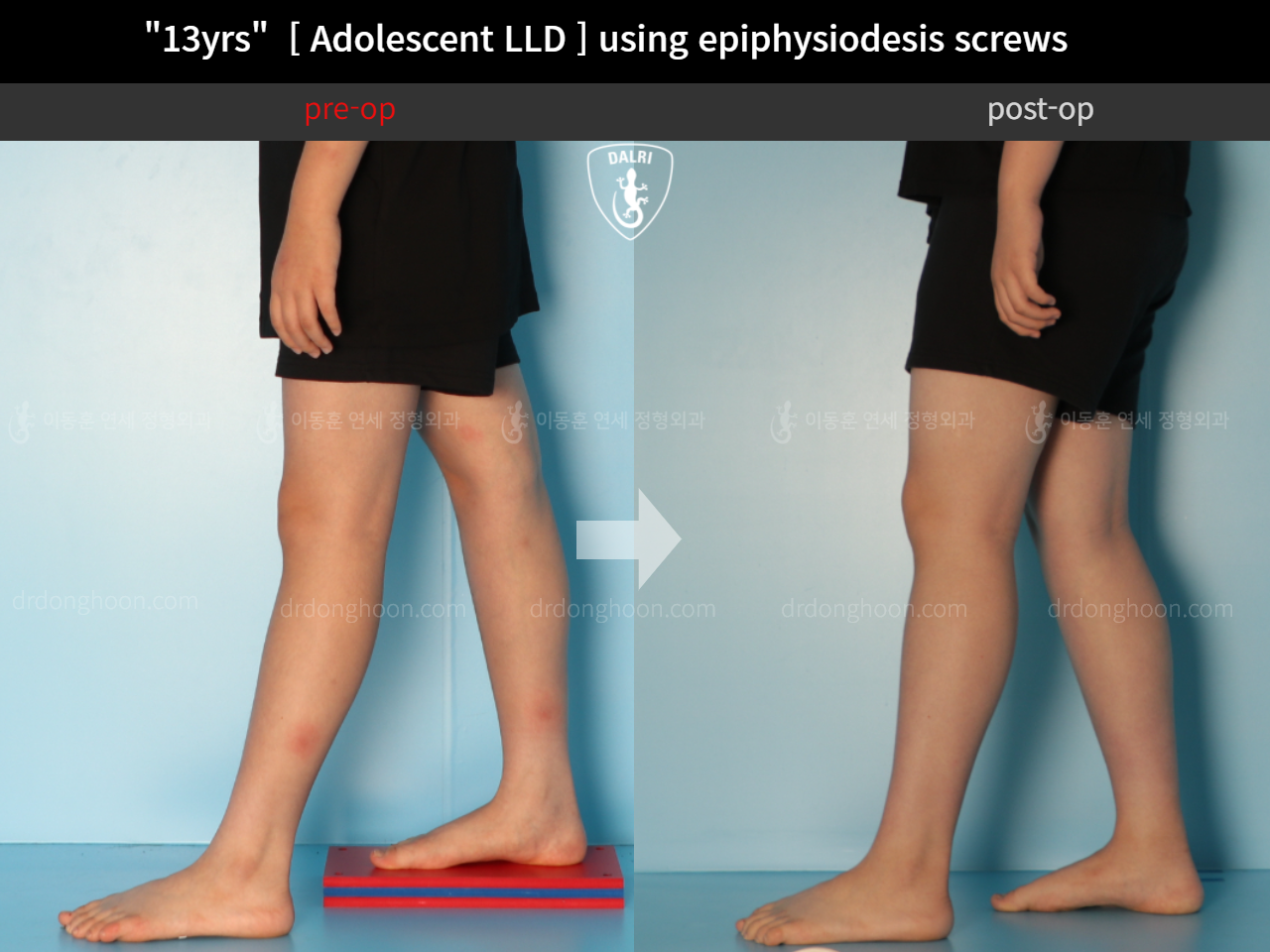 Before and after paediatric & adolescent lld, case 11773378, image 6, Dr. Donghoon institute (DALRI)