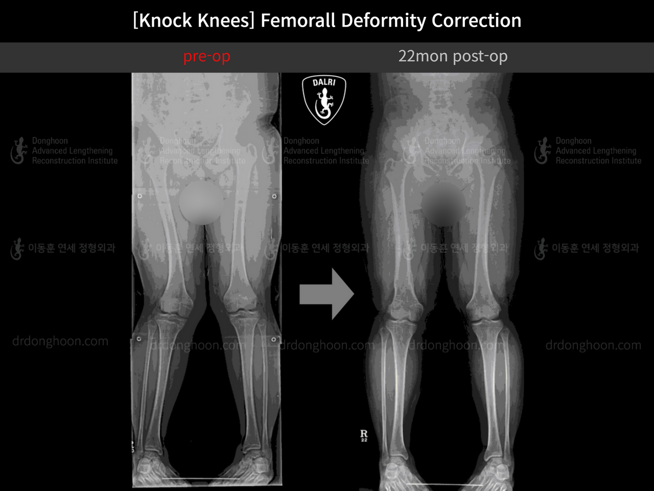 Before and after adult knock knees, case 12760284, image 5, Dr. Donghoon institute (DALRI)
