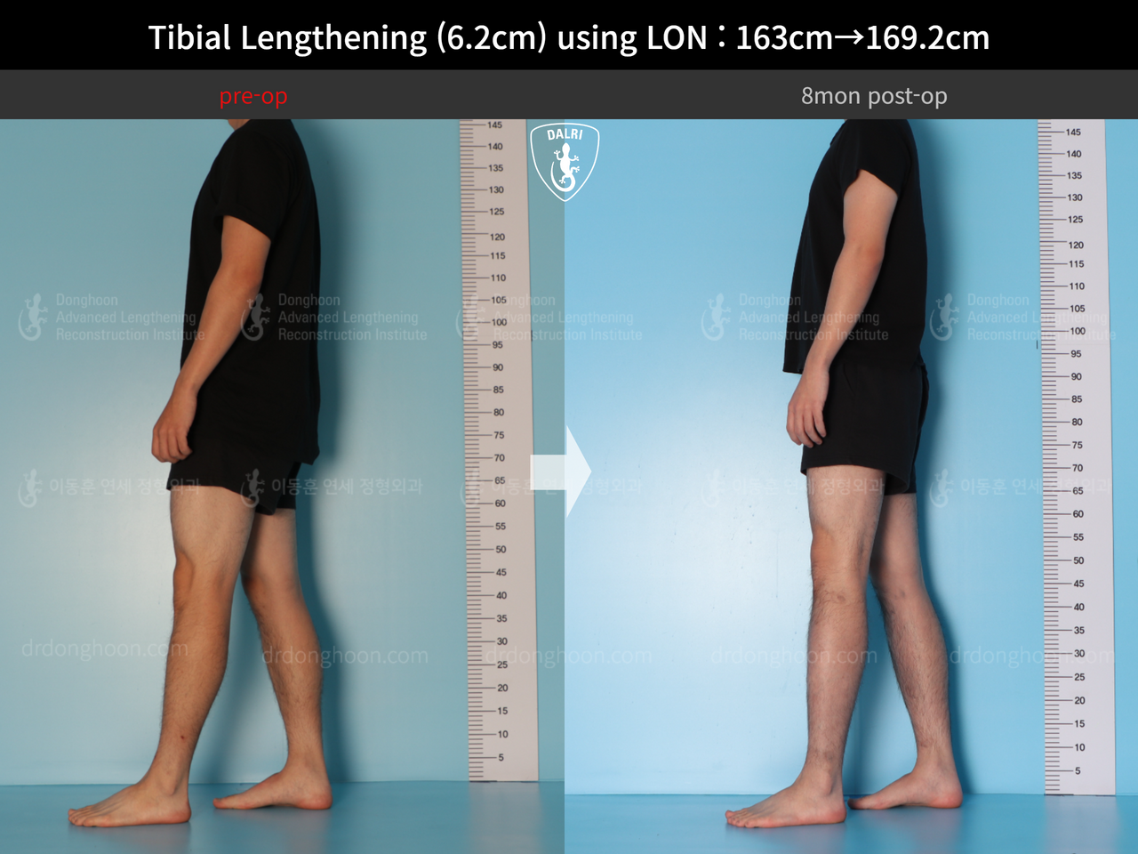 Before and after cll lon, case 14135787, image 5, Dr. Donghoon institute (DALRI)
