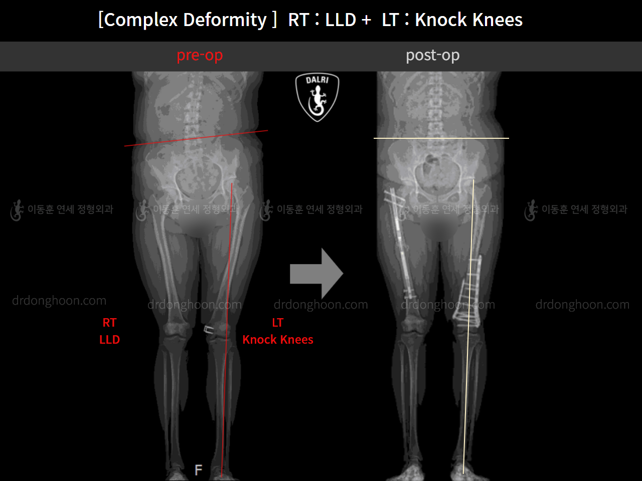 Before and after adult lld, case 10524998, image 5, Dr. Donghoon institute (DALRI)