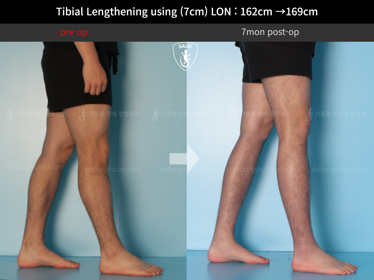 Before and after cll lon, case 13743472, image 11, Dr. Donghoon institute (DALRI)