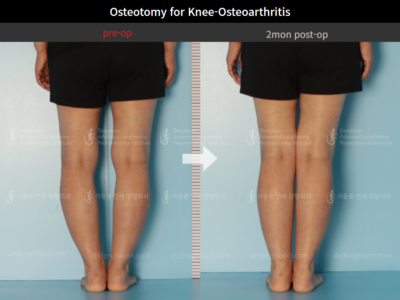 Before and after osteotomy for knee osteoarthritis, case 8826307, image 4, Dr. Donghoon institute (DALRI)