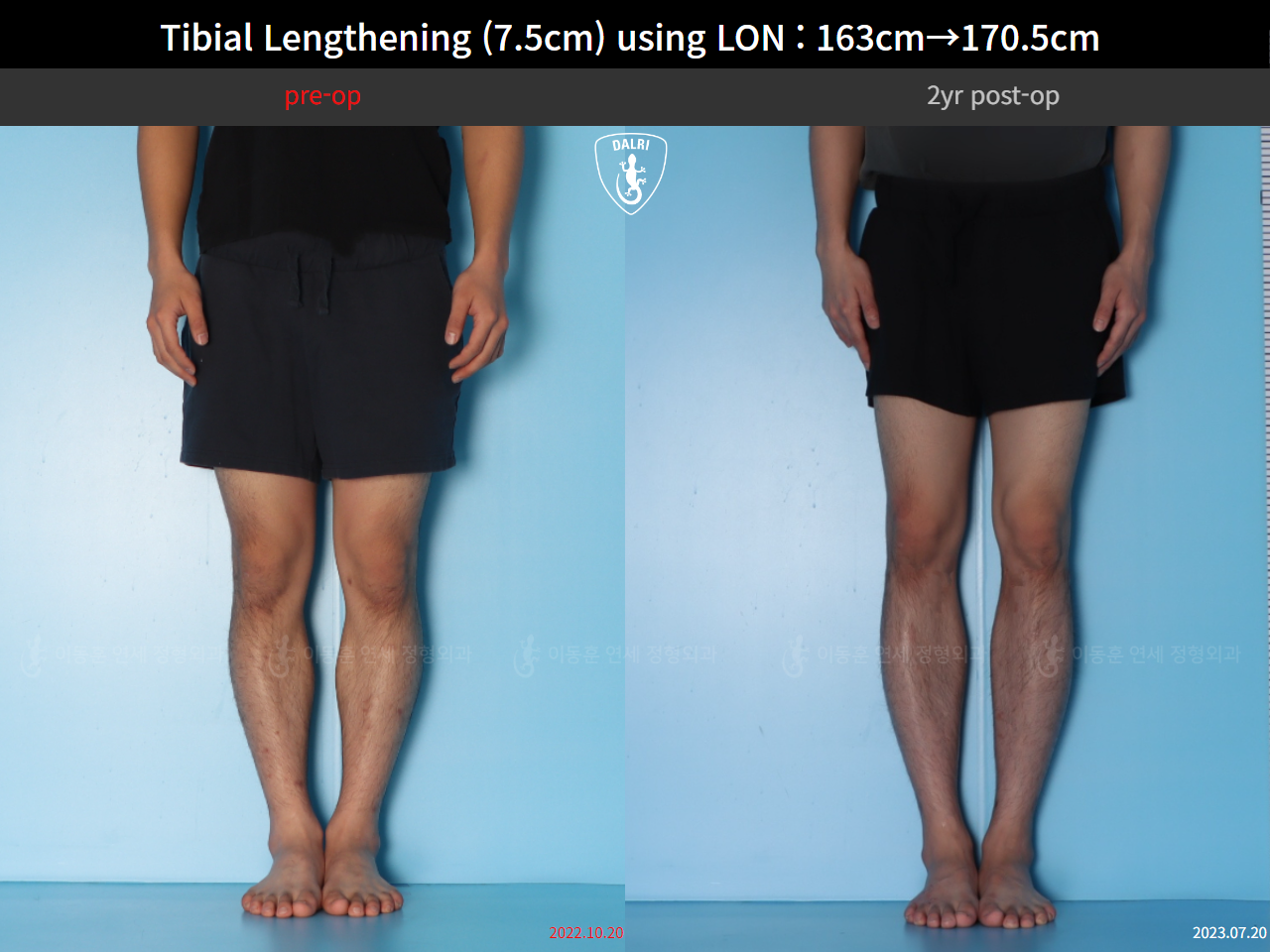 Before and after cll lon, case 125785462, image 9, Dr. Donghoon institute (DALRI)