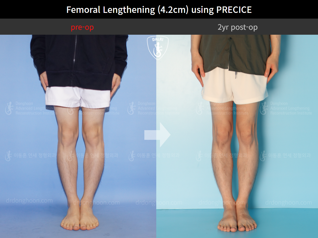 Before and after cll precice, case 4323396, image 5, Dr. Donghoon institute (DALRI)