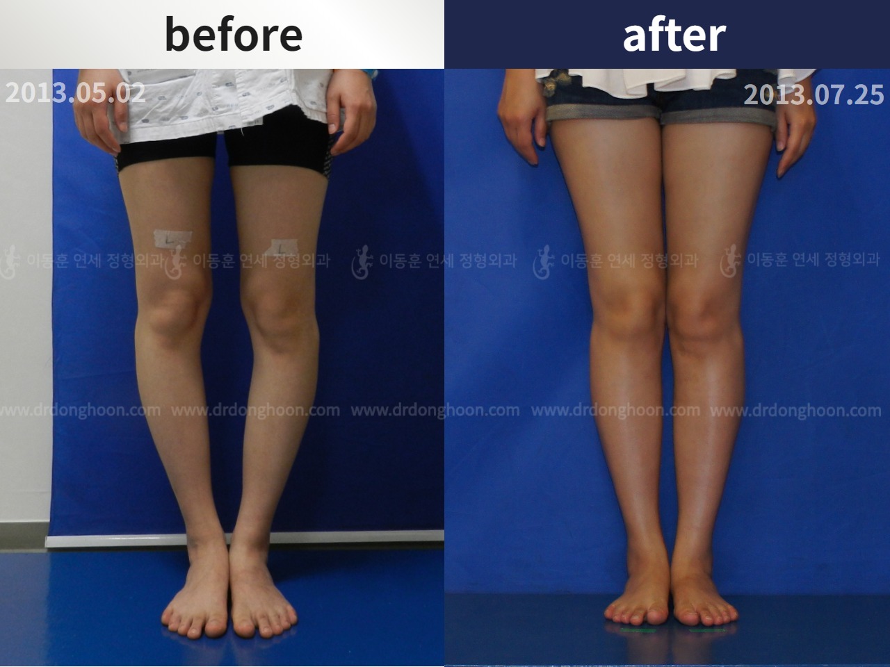 Before and after adult bowlegs, case 4586251, image 1, Dr. Donghoon institute (DALRI)