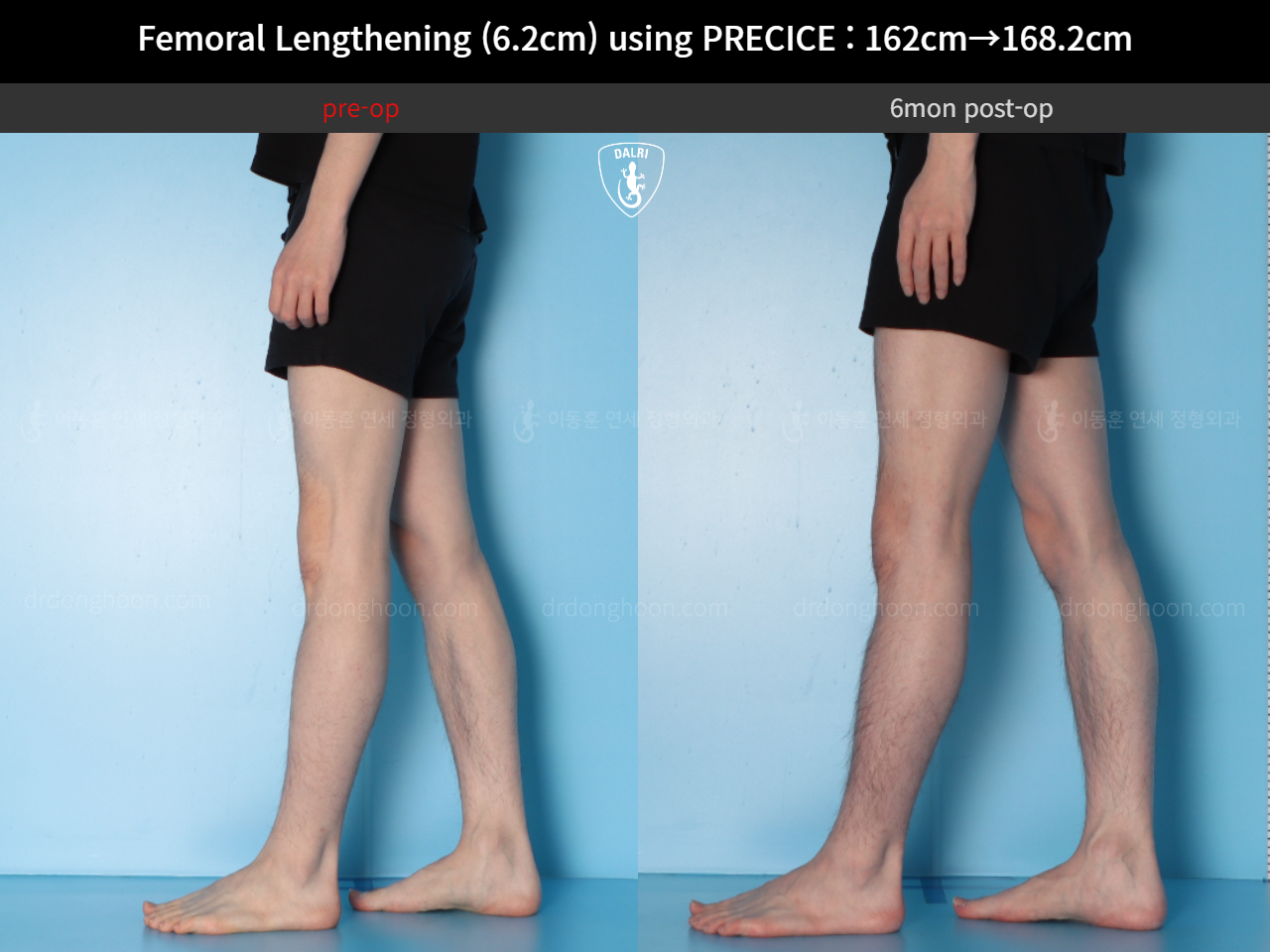 Before and after cll precice, case 15393865, image 12, Dr. Donghoon institute (DALRI)
