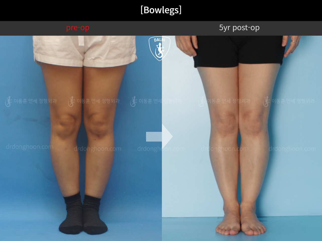 Before and after adult bowlegs, case 13567064, image 3, Dr. Donghoon institute (DALRI)