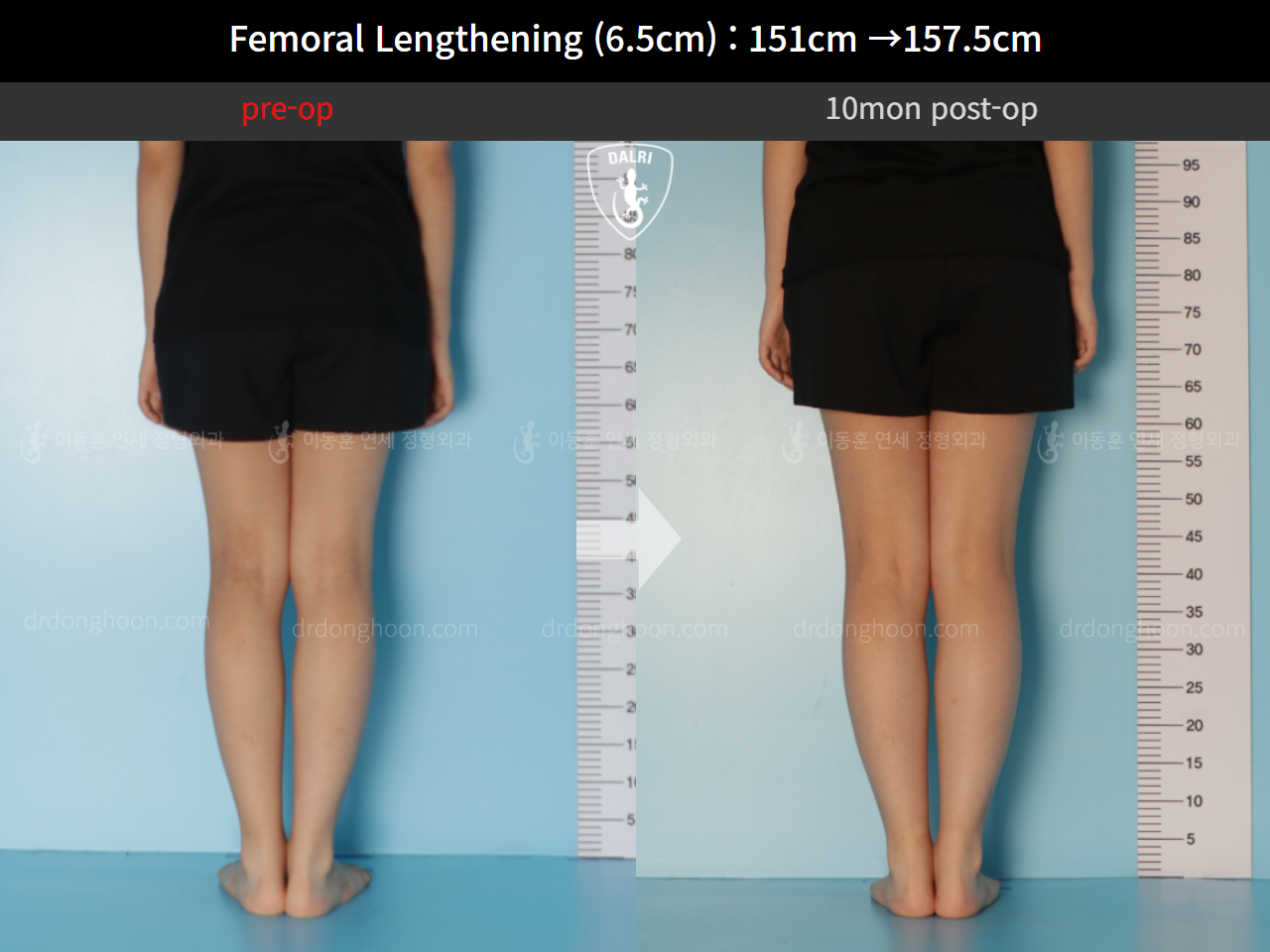 Before and after cll precice, case 10471188, image 6, Dr. Donghoon institute (DALRI)