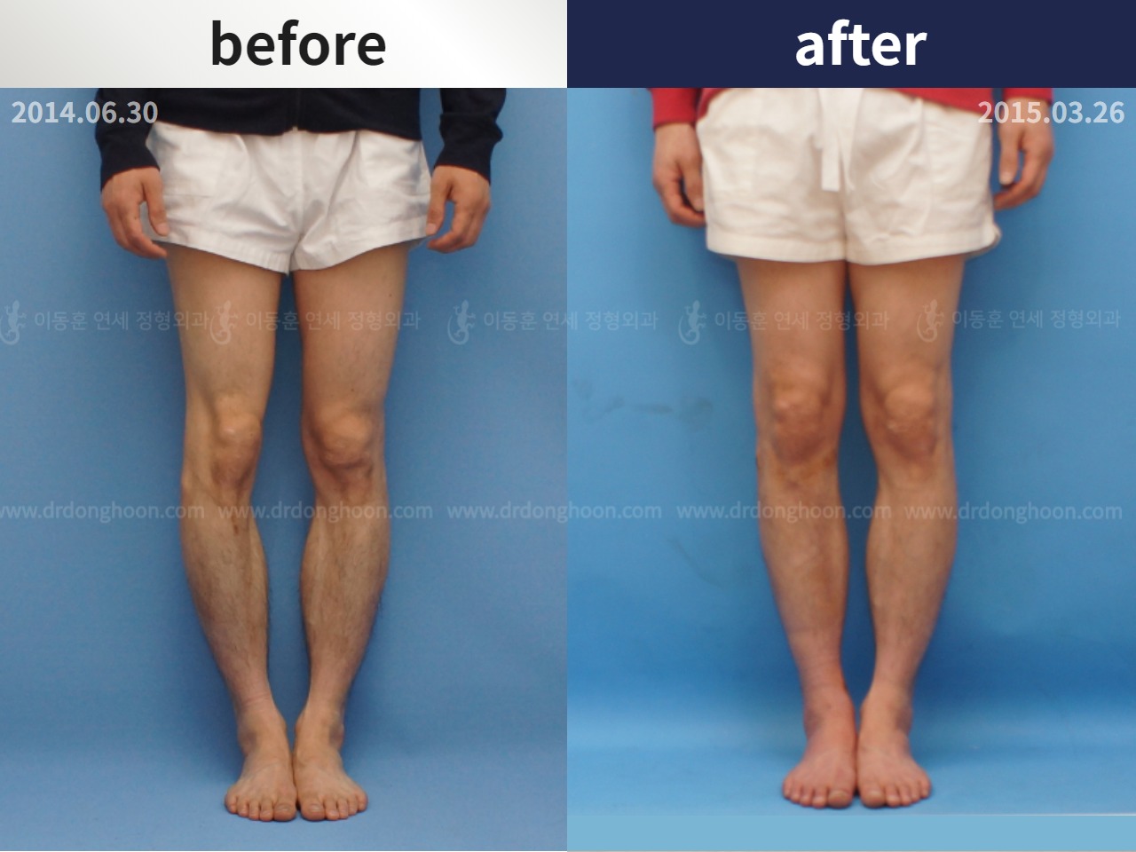 Before and after adult bowlegs, case 4311368, image 1, Dr. Donghoon institute (DALRI)