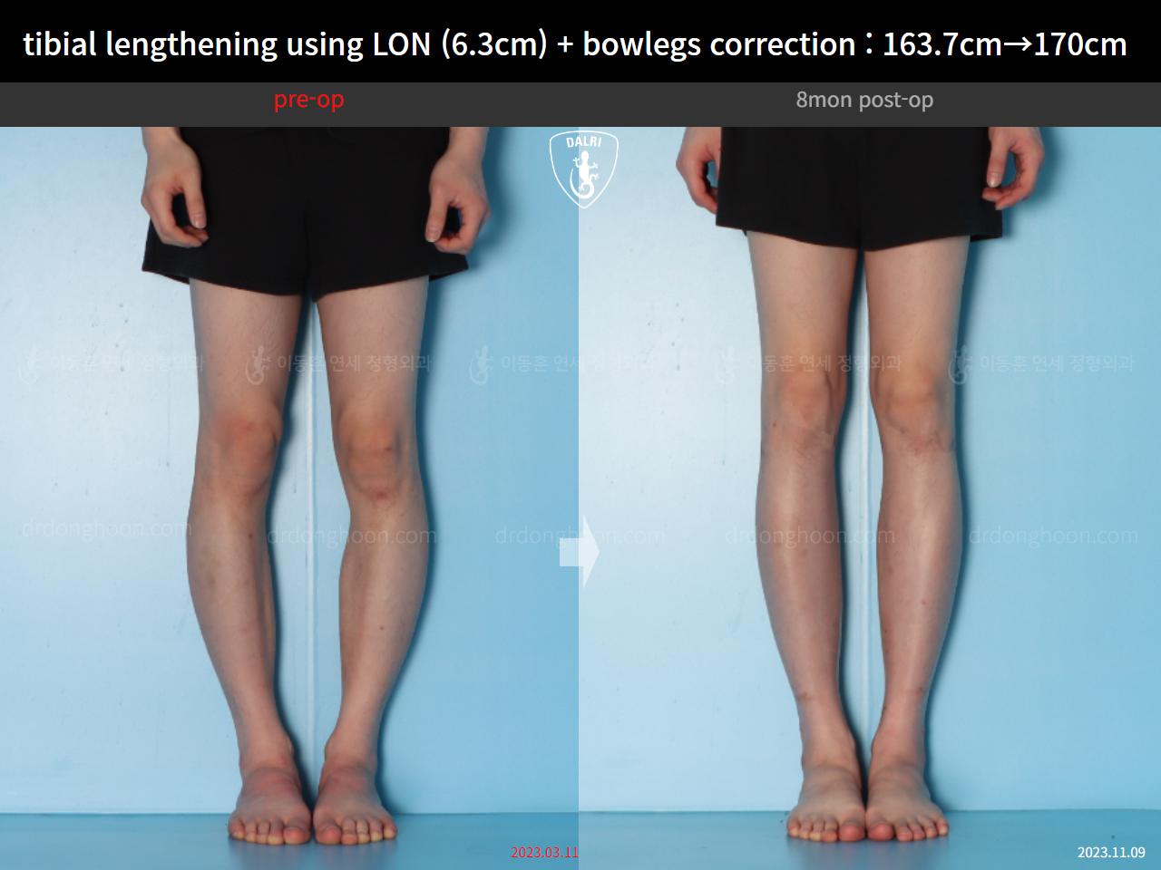 Before and after cll + deformity correction, case 16853829, image 7, Dr. Donghoon institute (DALRI)