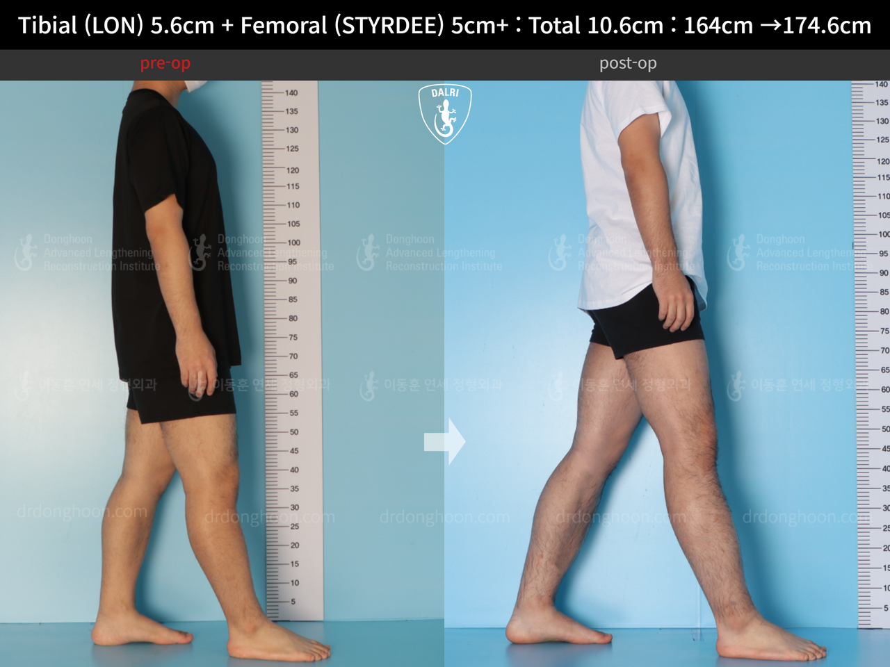 Before and after cll precice, case 13942494, image 7, Dr. Donghoon institute (DALRI)