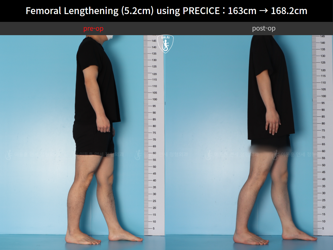Before and after cll precice, case 55585697, image 6, Dr. Donghoon institute (DALRI)