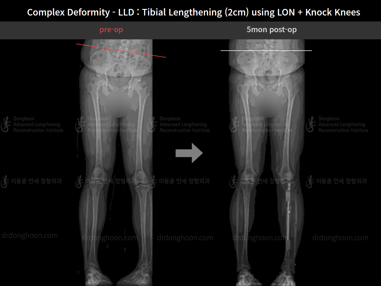 Before and after complex deformity, case 8394665, image 6, Dr. Donghoon institute (DALRI)