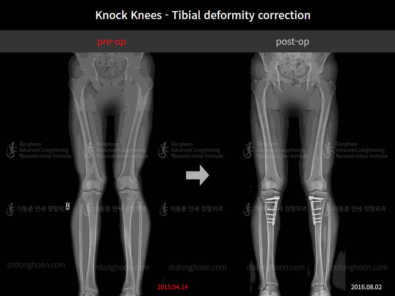 Before and after adult knock knees, case 4310817, image 3, Dr. Donghoon institute (DALRI)