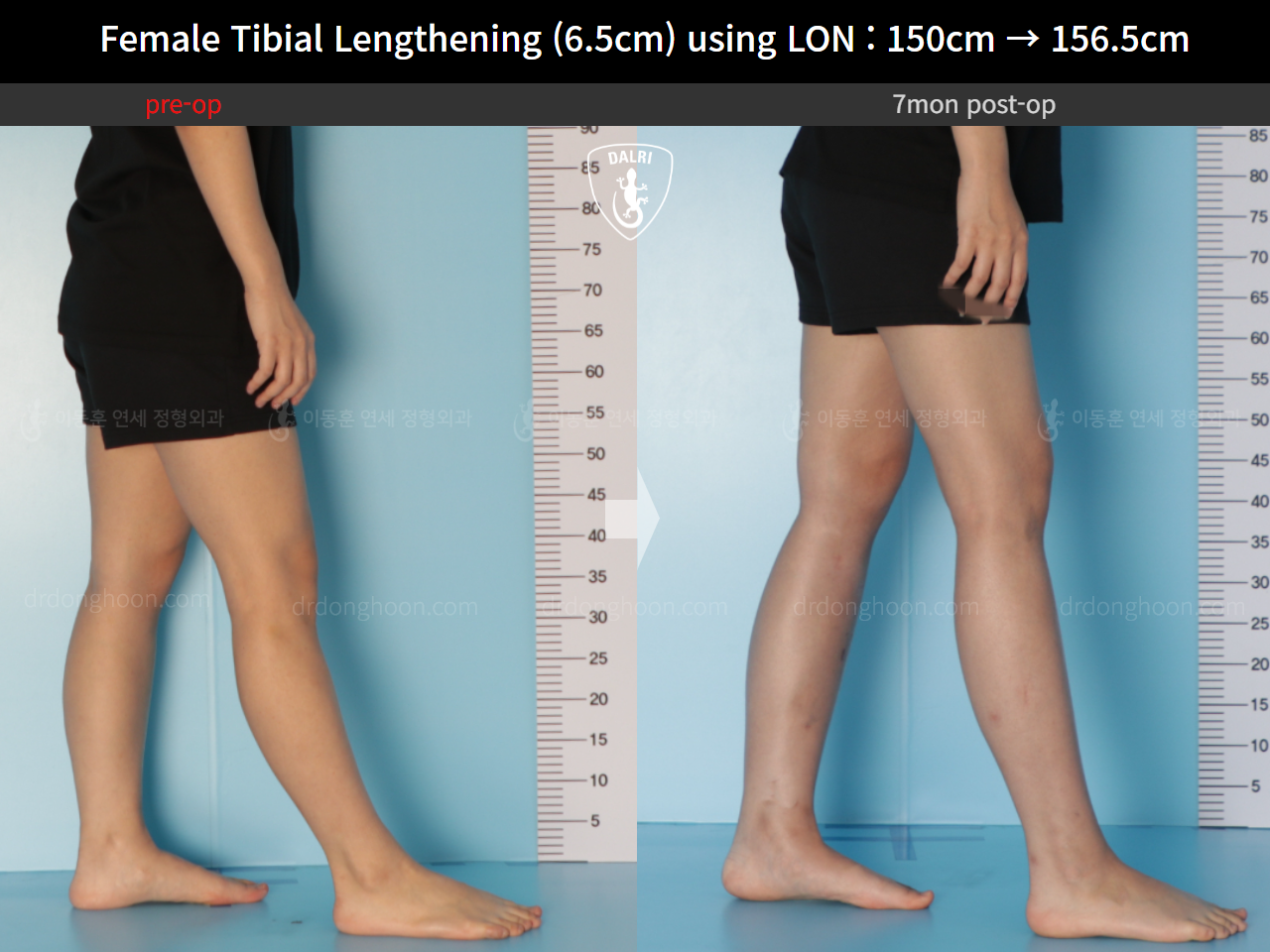 Before and after cll lon, case 16061220, image 8, Dr. Donghoon institute (DALRI)