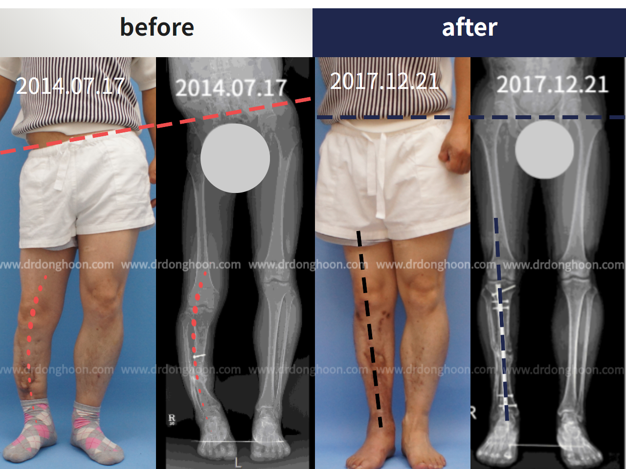 Before and after post-trauma deformity, case 4251810, image 3, Dr. Donghoon institute (DALRI)