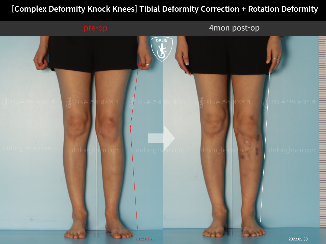 Before and after adult knock knees, case 11747832, image 3, Dr. Donghoon institute (DALRI)